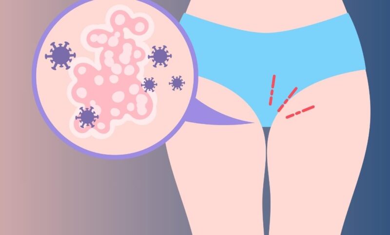 Dealing With Recurrent Yeast Infections